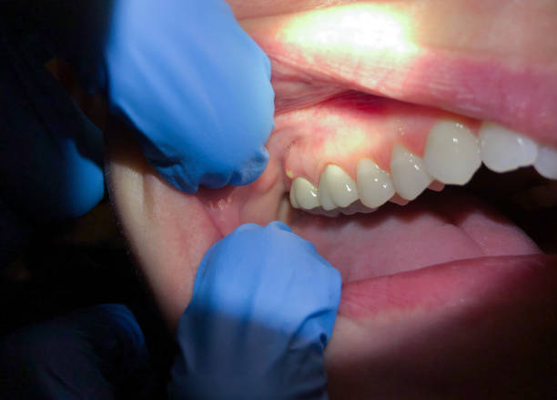 Best Emergency Gum Treatment in Mastic, NY
